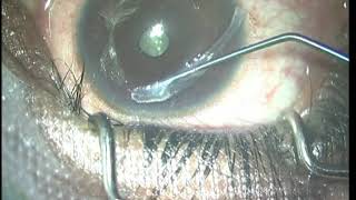 CAIRS Corneal Allogeneic Intrastromal Ring Segments for keratoconus ectasias amp irregular corneas [upl. by Seaden83]