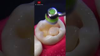 Eliminación de caries y restauración satisfying [upl. by Enomahs637]