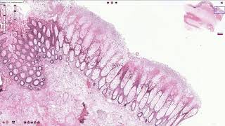 Pseudomembranous Colitis  Histopathology [upl. by Neltiac523]