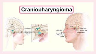 craniopharyngioma [upl. by Benson]