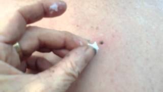 Painless Method to Remove Tick DONT pull it whatever you do [upl. by Oigres546]