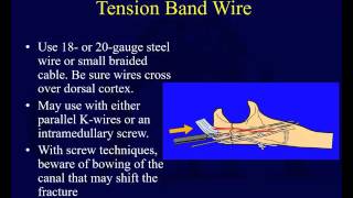 Olecranon Fractures [upl. by Anehsuc]