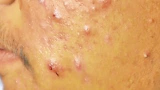 Extraction boutons et drainage le pus suintant dun acné kystique sur le visage  cystic acne [upl. by Manard]