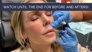 Volbella Lip Filler With Before and After Photos [upl. by Krute]