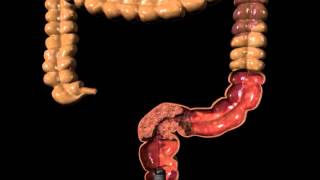 Cook Evolution duodenal amp Colonic Animation stent placement [upl. by Royal]