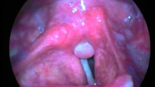 Granuloma Posterior Laringewmv [upl. by Nwadrebma]