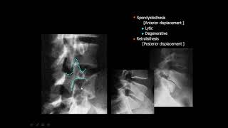 normal and abnormal spinal X ray part 2 [upl. by Sinaj]