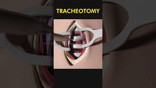 Tracheotomy 😷 explained [upl. by Paten]