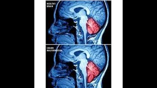 Chiari Malformation Type 115 month post op Memory loss post surgery when does PT start Over Fifty [upl. by Ilime]