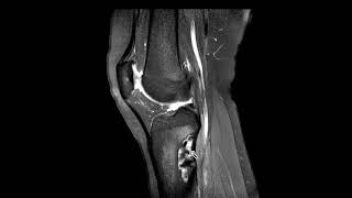 Non ossifying fibroma NOF of tibia [upl. by Eeslehc]