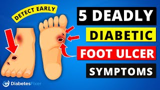 5 DEADLY Diabetic FOOT Ulcer Signs [upl. by Enale]