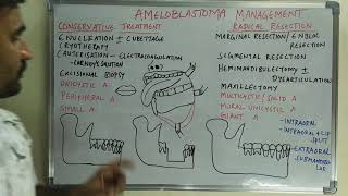 Ameloblastoma management [upl. by Kuska35]