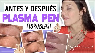 PLASMA PEN FIBROBLAST ANTES Y DESPUÉS  plasma pen  plasmapen plasmafibroblast CarolinaTV [upl. by Schulman]