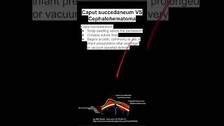 Caput succedaneum VS Cephalohematoma [upl. by Nemsaj]