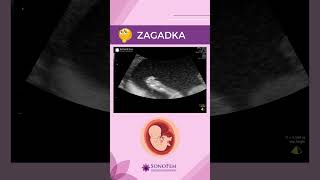 Zagadka z USG ciąży 🤰 ciąża USG5D usgciążywarszawa [upl. by Ahsilram528]