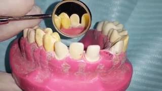 all ceramic crown preparation for Maxillary canine quotU3quot [upl. by Rimas]