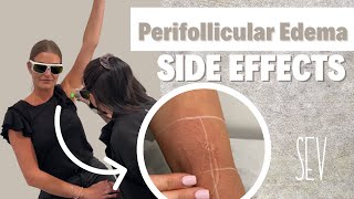 Perifollicular Edema Common Laser Hair Removal Side Effect [upl. by Niboc]