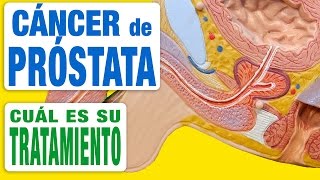 Cáncer de Próstata  Tratamiento [upl. by Lochner]