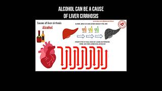 Alcohol can be a cause of liver cirrhosis alcohol livercirrhosis cirrhosis cirrhosiscauses [upl. by Yessydo878]