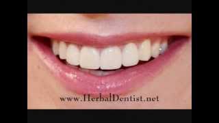 Herbal Dentist  1 Natural Gum Disease Remedy wwwherbaldentistnet [upl. by Winnie600]