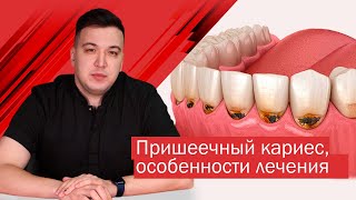 Пришеечный кариес виды лечение профилактика [upl. by Enilekaj21]