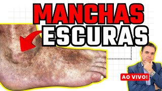 Manchas ESCURAS nos PÉS e PERNAS  AO VIVO  Dr Alex Vascular [upl. by Ennael]