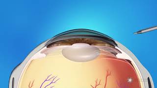 What is Refractive Lens Exchange Surgery [upl. by Siul]