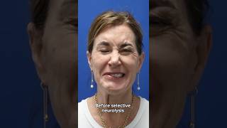 HUGE transformation after selective neurolysis surgery plasticsurgery facialparalysis facialpalsy [upl. by Aimek279]