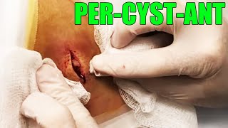 Double Bubble Cyst Dr Gilmore Cyst Removal [upl. by Treble]