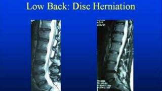 Low Back Anatomy with pinched nerves disc ruptures amp pain [upl. by Eyahsal]