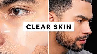 How To Get Clear Skin Only 3 Steps [upl. by Ahsoyek433]