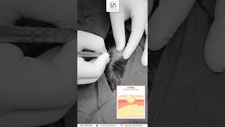 Scalp Lipoma Removal Quick amp Painless Procedure at Restore Clinic Navi Mumbai [upl. by Krid]