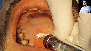 Local Anesthesia Greater Palatine Nerve Block Technique Maxillary anesthesia Techniques dentistry [upl. by Benedikta]