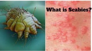 what is scabies sign symptomscauses and treatment [upl. by Adnarom]