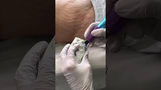 Stretch Marks Inkless Removal Boleyn Treatment Los Angeles 🌍 shorts [upl. by Tench]