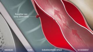 Pseudoaneurysm of the V4 segment of the vertebral artery [upl. by Dent997]