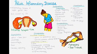 Pelvic Inflammatory Disease [upl. by Daigle]