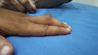 Middle finger in ligament injuryligament [upl. by Anirbus]