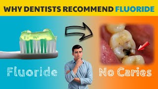 History of FLUORIDE and CARIES in 2 minutes [upl. by Ivar108]