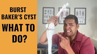 Baker’s Cyst Burst Help  Why It Happens amp What To Do Next [upl. by Groves]