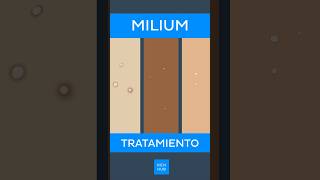 Milium Tratamiento  Kenhub milium [upl. by Hazrit450]