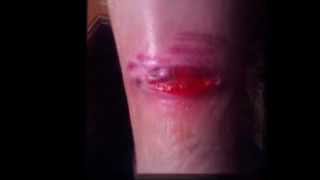 My chainsaw wound 60 days to healed [upl. by Eerised]