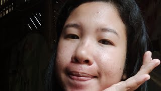 7days result Using peeling lotion [upl. by Naejarual]