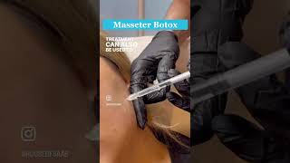 Masseter Botox Treatment jawline goalsmasseterbotox masseter [upl. by Doig]