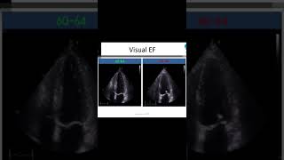 EF 4930  eyeball estimation visual EF ejection fraction echocardiography [upl. by Odlopoel242]