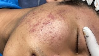 ACNE TREATMENT VU QUYNH MI  Blackheads Of Tweens 2024 EX [upl. by Anwahs51]