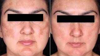 Obagi Nu Derm Before amp After Results [upl. by Natanoj]