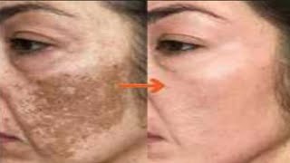 Pigmentation treatment at Homeپگمنٹیشن کا مسئلہ ہی ختم [upl. by Cloris]