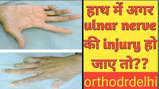 ulnar nerve examination injury का पता कैसे करेulnar nerve injury Hindi [upl. by Zennas188]