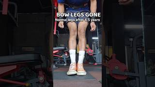 Legs alignment After bow legs surgery bowlegs [upl. by Anerda]